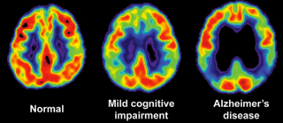 Alzheimer Disease