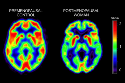 Menopause and Alzheimer's